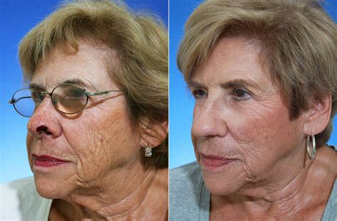 Mohs Nose Before And After Steiger Facial Plastic Surgery Boca