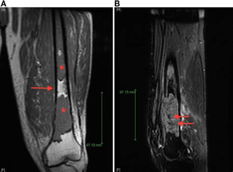 Coronavirus disease programme online course: Frontiers | Synchronous Bone Metastasis From Multiple ...