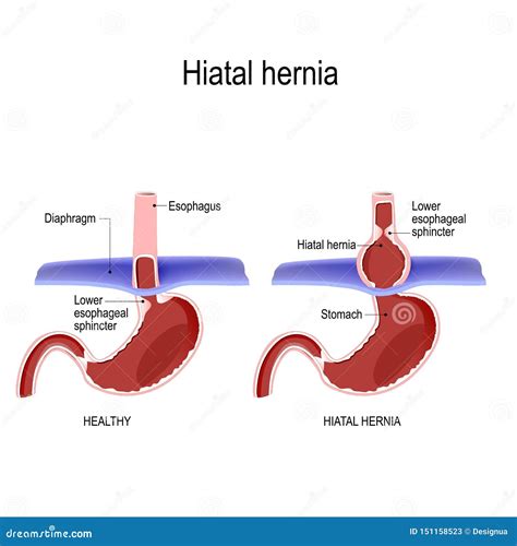 Hiatal Hiatal Hernia And Normal Anatomy Of The Stomach Stock Vector Illustration Of Hiatal
