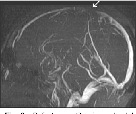 Figure 2 From Trombosis Venosa Cerebral En Un Paciente Con Colitis