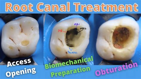 root canal treatment in maxillary first permanent molar 🟠 how to locate mesiobuccal canals mb1