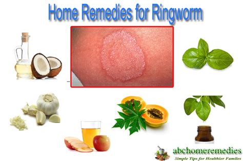 11 Desirable Home Remedies For Ringworm Abchomeremedies