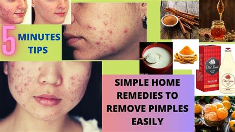 How To Remove Pimples At Home Acne Treatment Home Remedies For