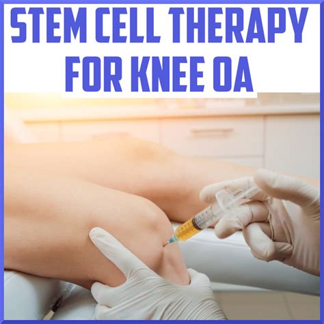Stem Cell Treatment For Knee Osteoarthritis Sports Medicine Review