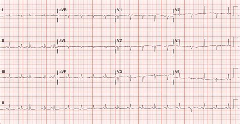 Which Lead Ecg Findings Suggest Cardiac Tamponade My Xxx Hot Girl