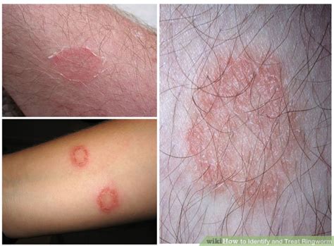 Learn How To Do Anything How To Identify And Treat Ringworm