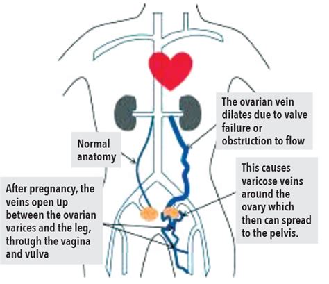 Vulvar Varicosities A Warning Sign Of Vascular Disorder Center For