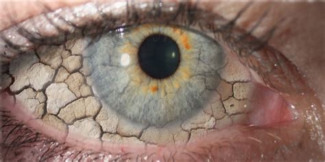 Tratamiento Del Ojo Seco I Manejo Inicial Ocularis