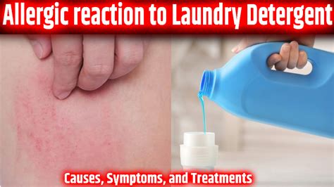 Allergic Reaction To Laundry Detergent Causes Symptoms And Treatments