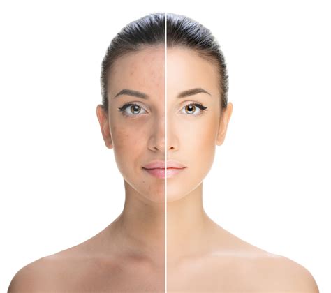 Topical Skin Lightening Agents Can Combat Hyperpigmentation