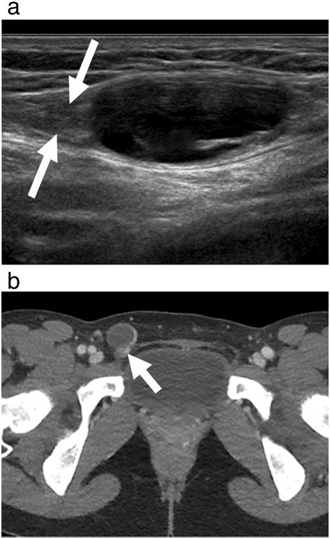 Sonographic Evaluation Of Inguinal Lesions Clinical Imaging