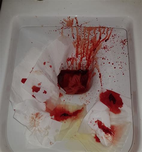 Warning Graphic Photo Is This Normal Bleeding For Haemorrhoids