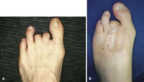 Icd 10 Code For Chronic Osteomyelitis Right Second Toe