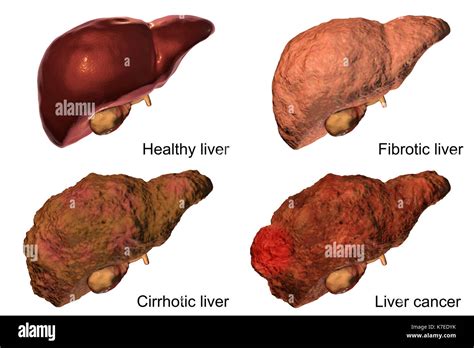 Human Liver Showing Stages Of Liver Disease Computer Illustration