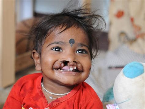What Is A Cleft Future Faces