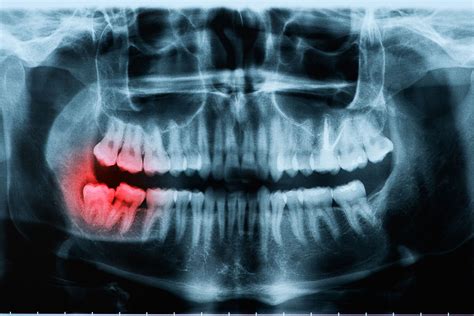 Wisdom Teeth Roanoke Oral Surgery