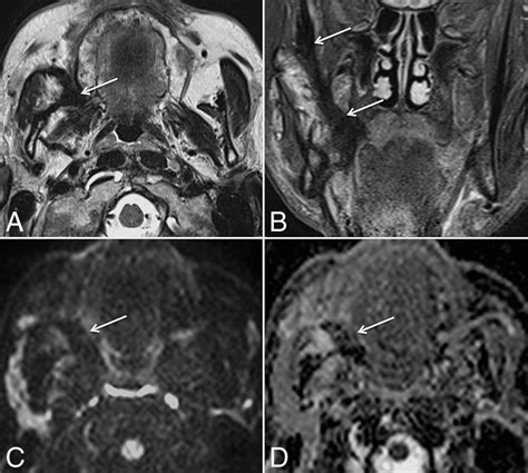 Mri With Dwi For The Detection Of Posttreatment Head And Neck Squamous