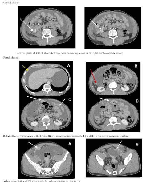 Radiological Findings Peritoneal Carcinomatosis Sumers Radiology Blog