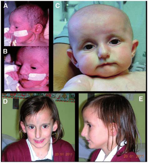 Photographs Of The Individual With Pkce Short Syndrome A B
