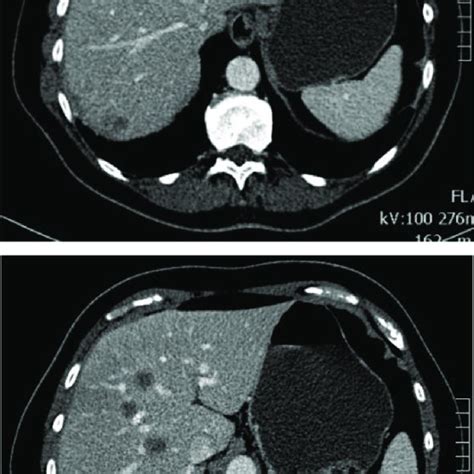 Contrast Enhanced Ct Abdomen In The Portal Venous Phase Multiple Focal