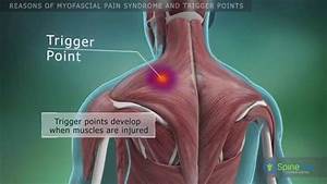 Myofascial Syndrome And Trigger Points Reasons Youtube