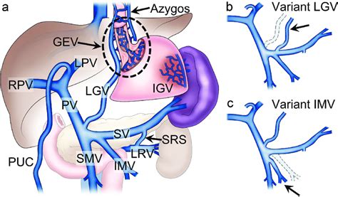 Anatomical Schematics Of The Portal Venous Circulation A Illustrates