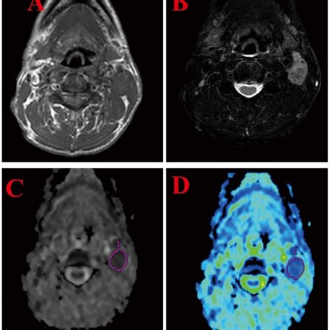 Mri And Dwi In A Patient With Metastatic Cervical Lymph Nodes Of