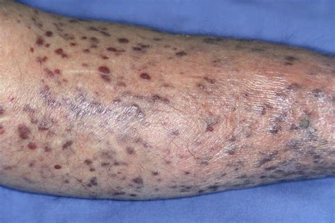 Risk For Secondary Tumors After Kaposi Sarcoma Has Changed In The Haart