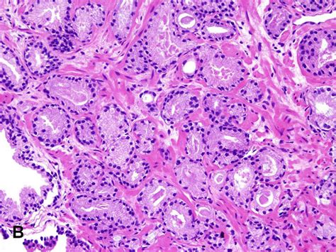 Prostatic Adenocarcinoma Gleason Grade 3 3 Prostatic Adenocarcinoma