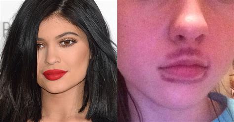 Kyliejennerchallenge Teens Faces Bruised Swollen In Ritual
