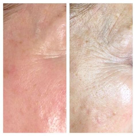 Rejuvapen Nxt® Microneedling Fort Worth And Decatur Tx Ideal Skin Medspa