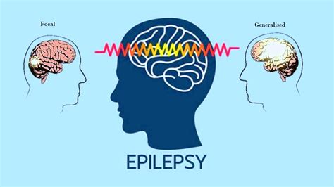 Epilepsy Seizure Homeopathic Treatment