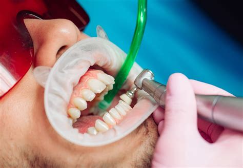 Know More About Dental Deep Cleaning Technique Tooth Scaling And