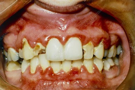 Gum Disease Stock Image M7820011 Science Photo Library