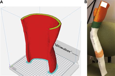 Volumetric Modulated Arc Therapy And 3 Dimensional Printed Bolus In The