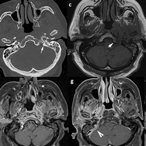 A 66 Year Old Woman Was Treated With The Diagnosis Of Left Sided Noe