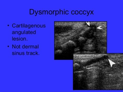 Neonatal Spine Ultrasoundnormal And Abnormal Findings