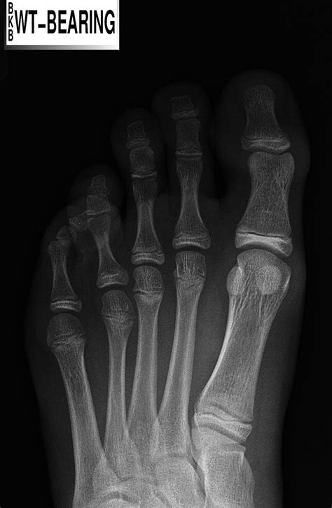 Hammer Toe Signs Symptoms Garzaenrteomllr