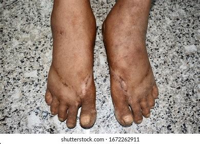 Pitting Oedema Foots Cirrhosis Patient Chronic Stok Foto Raf