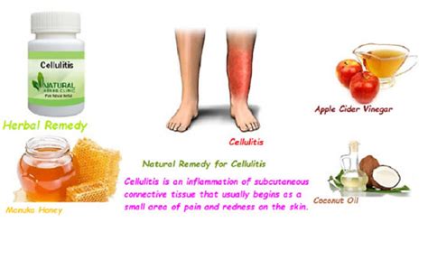 Cellulitis Archives Natural Herbs Clinic Blog