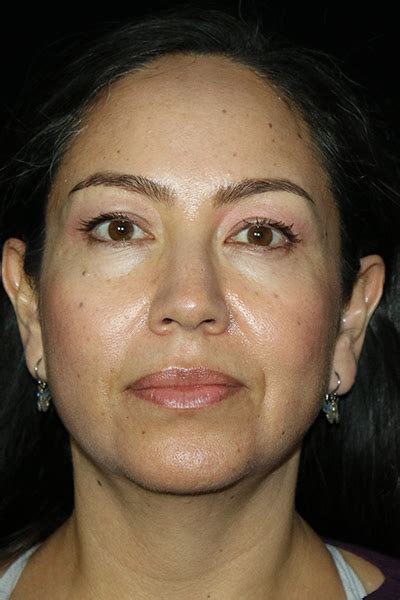 Patient 12510 Facial Fat Grafting Before And After Photos San Diego