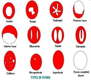 Hymen Types