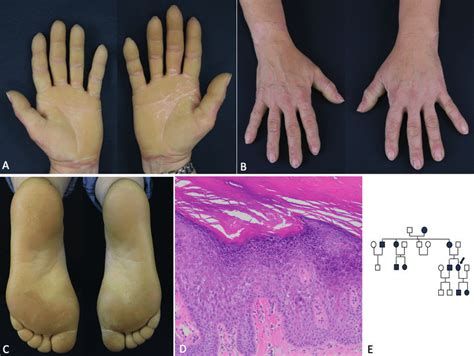 A C A Diffuse Symmetrical And Sharply Defined Hyperkeratosis