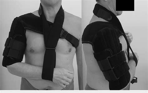 The Humeral Brace Used For Conservative Treatment Clasby Humeral