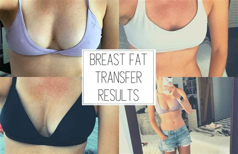 My Breast Fat Transfer Results Ancestral Nutrition