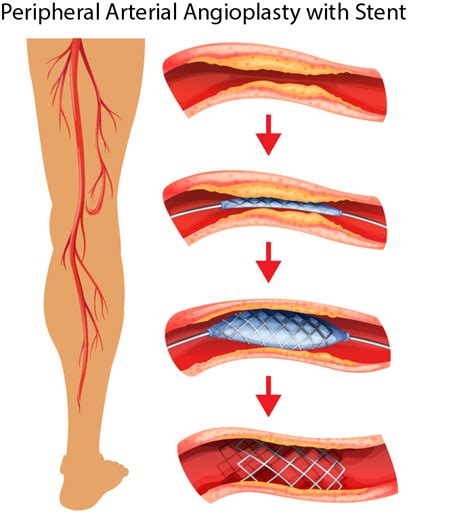 peripheral arterial angioplasty stent placement elite cardiovascular group