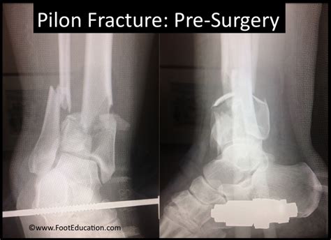Pilon Fracture Footeducation