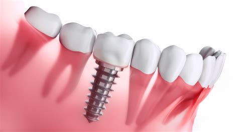 Everything You Need To Know About Dental Implants Starbright Dental