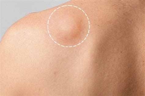 Lipoma Penyebab Gejala Pengobatan Dan Komplikasi