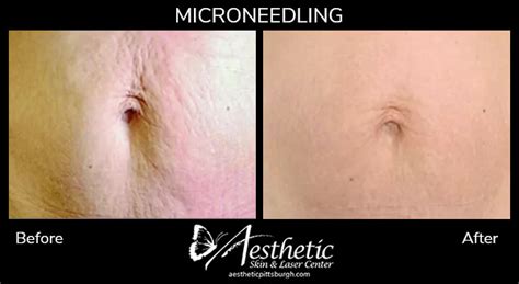 Collagen Pin Microneedling Before And After Photos Pittsburgh Pa